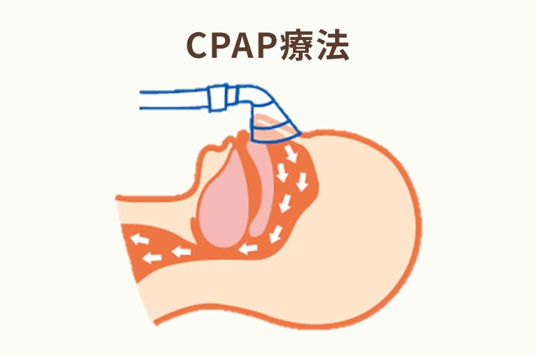 CPAPってどんな治療なの？